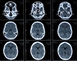 سی تی اسکن مغز, سی تی اسکن , brain ct scan